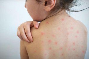 Случаите на морбили в България нараснаха до 101