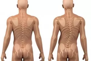  Сколиоза най-често се открива след 10-годишна възраст