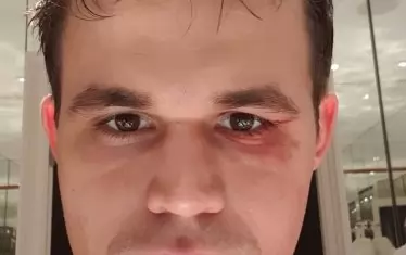 Световният шампион по шахмат Магнус Карлсен показа в социалните мрежи насиненото си око след футболен инцидент. Норвежецът обясни, че е получил травмата, докато е разпускал в един от почивните дни на мача за световната титла срещу претендента Фабиано Каруана. Три партии преди края на срещата в Лондон резултатът беше равен - 4,5:4,5 т., след девет последователни ремита в първите 9 от общо 12 класически партии.