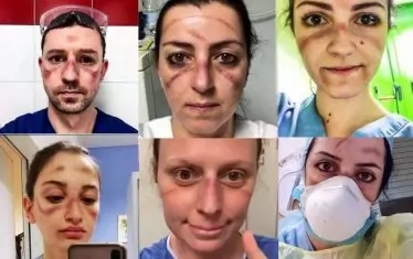 Младите лекари и сестри с белезите от предпазните маски. Техният избор