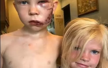  Бриджър и сестра му след инцидента. 