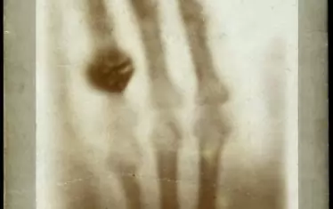 Първата рентгенова снимка на човешка ръка е на ръката на съпругата му Анна, както е с пръстена си, 1895 г. Тя се уплашила, като я видяла, защото помислила, че вижда смъртта си.