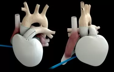 Първата в света продажба на изкуствено сърце е факт
