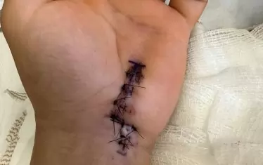 Лявата длан на Йоанис след претърпяната операция на 24 юни.